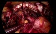 SELS - BURCH Urethropexy