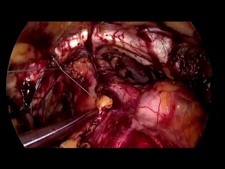 SELS - BURCH Urethropexy