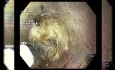 Gastric Tunnelling ESD of a HG Dyplasia Lesion