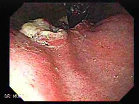 A Large Fungating and Ulcerating Lesion Presented at Gastric Fundus - Retroflexed View