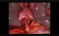 3 Ports Lap Cholecystectomy for Acute Cholecystitis