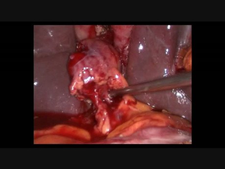 3 Ports Lap Cholecystectomy for Acute Cholecystitis