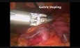 Sleeve Gastrectomy - Step by Step