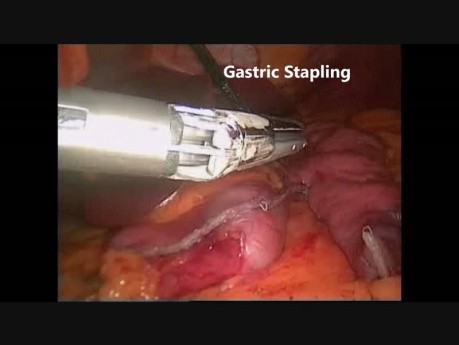 Sleeve Gastrectomy - Step by Step