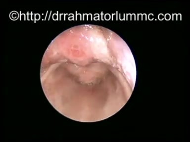 Congenital Vallecular Cyst - Endoscopic View