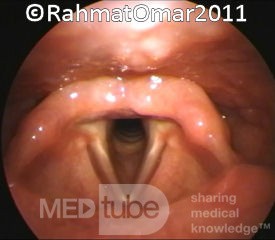 The Laryngeal Inlet