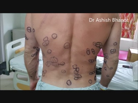 Multiple Lipoma Treatment