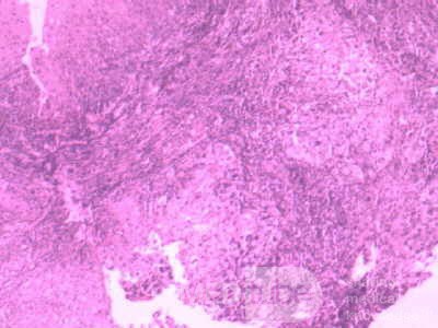 Distal Esophageal Squamous Cell Carcinoma (25of 28)