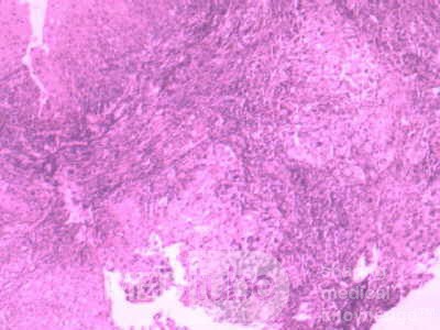 Distal Esophageal Squamous Cell Carcinoma (25of 28)