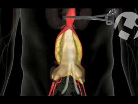 Improper Surgical Repair of Aortic Aneurysm