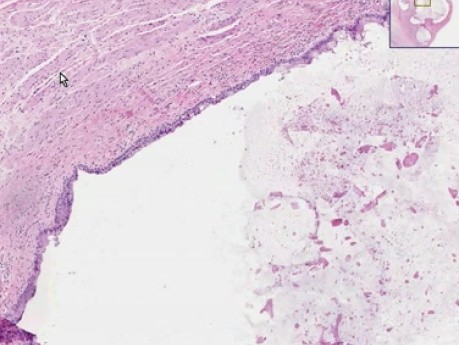 Benign teratoma