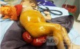 Rectal Prolapse In A Small Child - Other Shot