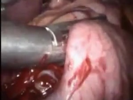 Laparoscopic sleeve gastrectomy