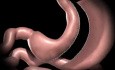 Sleeve Gastrectomy Animation