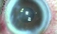 Cataract - plasma ablation