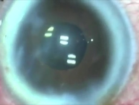Cataract - plasma ablation