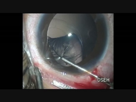 Lens implantation in ectopia lentis