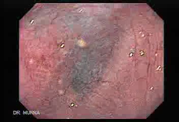 Esophageal Diverticula - Insertion of the Endoscope