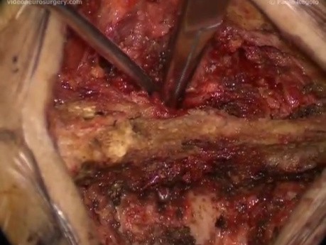 Lumbar Interspinous Arthrodesis - Posterior Approach