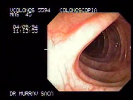 Transverse Colon