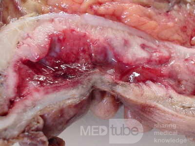 Rectal Adenocarcinoma (4 of 7)
