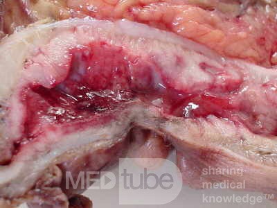 Rectal Adenocarcinoma (4 of 7)