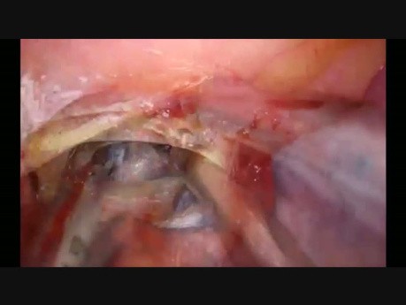 Uniportal VATS Lymph Node Dissection on the Left Side
