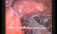 Thoracoscopic Resection of Germinal Mediastinal Mass