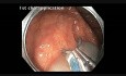 Colonoscopy Channel - Resection of Flat Lesion in Ascending Colon