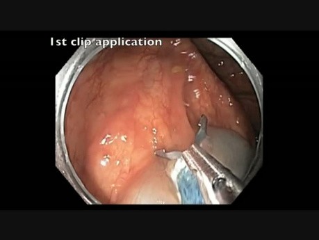 Colonoscopy Channel - Resection of Flat Lesion in Ascending Colon