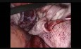 30-wks Size Choclate Cyst Excision