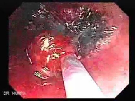 Endoscopic Resection of Giant Tubulo-Villous of the rectum (13 of 35)