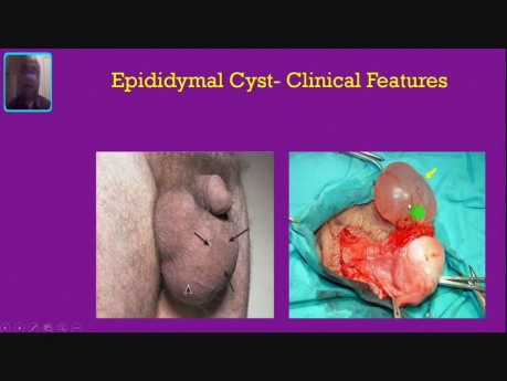 Scrotal Swellings - Case No 3 - Epididymal Cyst