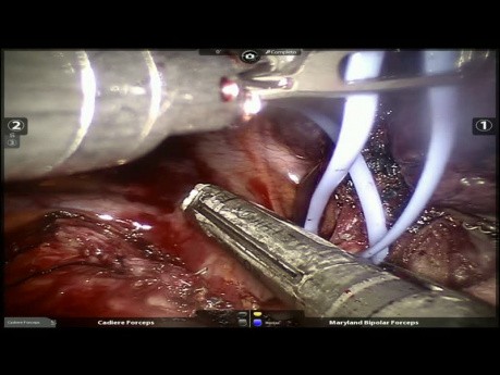 Lung Adenocarcinoma Invading the Cissura