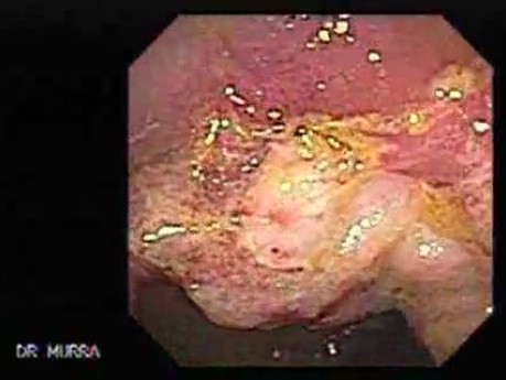 Cap polyposis that resemble a adenocarcinoma of the rectum (3 of 7)