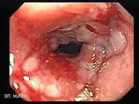 Esophagus - Pneumatic Dilation for Achalasia - Closer Look at the Lower Third of Esophagus