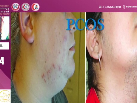 Metformin, Propranolol, Tranexamic Acid in Dermatology