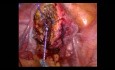 Challenges in Laparoscopic Management of Adenomyoma (Endometriosis Interna) in Infertility Patient