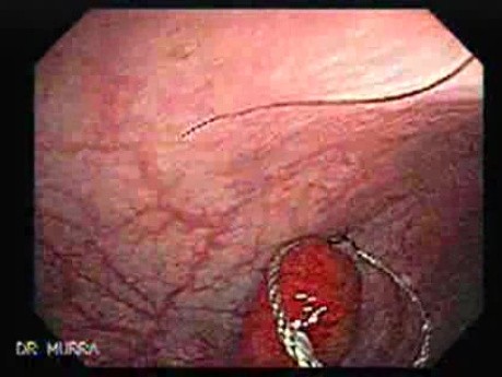 Endoscopic view of Rectal Stalked Polyp (1 of 7)