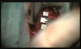 Anterior Cervical Microdiscectomy Followed by Arthroplasty Using Modern Mobile Implant