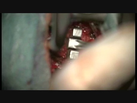 Anterior Cervical Microdiscectomy Followed by Arthroplasty Using Modern Mobile Implant