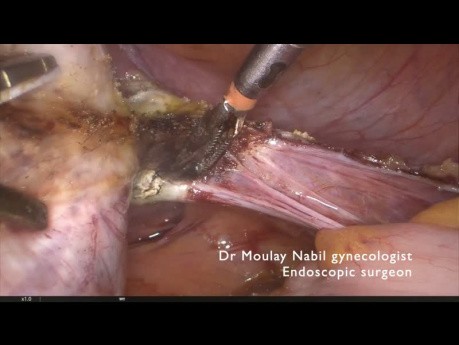 Tips and Tricks. Hysterectomy on huge uterus