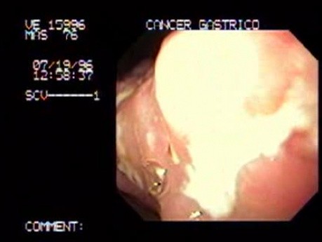 Gastric Adenocarcinoma With Multiple Ulcers - Endoscopy