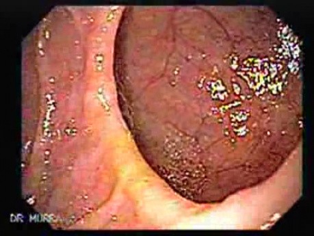 Duodenal Diverticula (1 of 2)