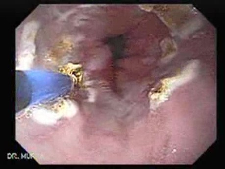 Endoscopic Ablation Of Barrett's Esophagus - 3/6