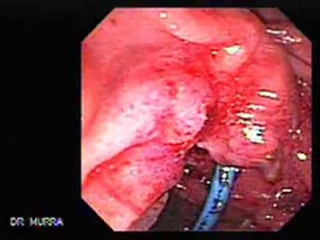 Adenocarcinoma of the Vater Papilla - Stent Migration (2 of 7)