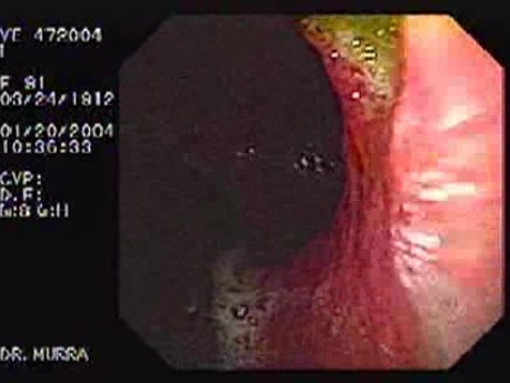 Giant Gastric Ulcer - Endoscopy (3 of 5)