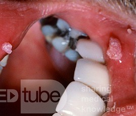 Papilloma of the Lip