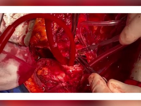 Aortic Arch Replacement with new Antegrade Perfusion Technique