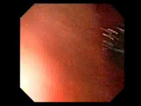 Transfistula Retrograde Endoscopy - Baloon Dilation Of The Gastrostomy Tract